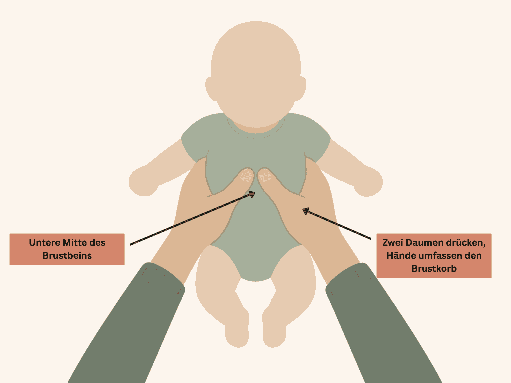 Illustration der Zwei-Daumen-Technik bei der Herzdruckmassage am Baby, Brustkorb umfasst