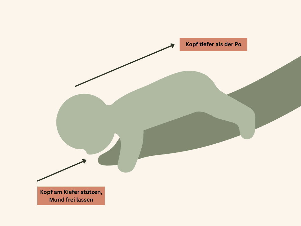 Illustration Rückenschläge beim Baby bei Verschlucken, bäuchlings über dem Unterarm, Kopf tief